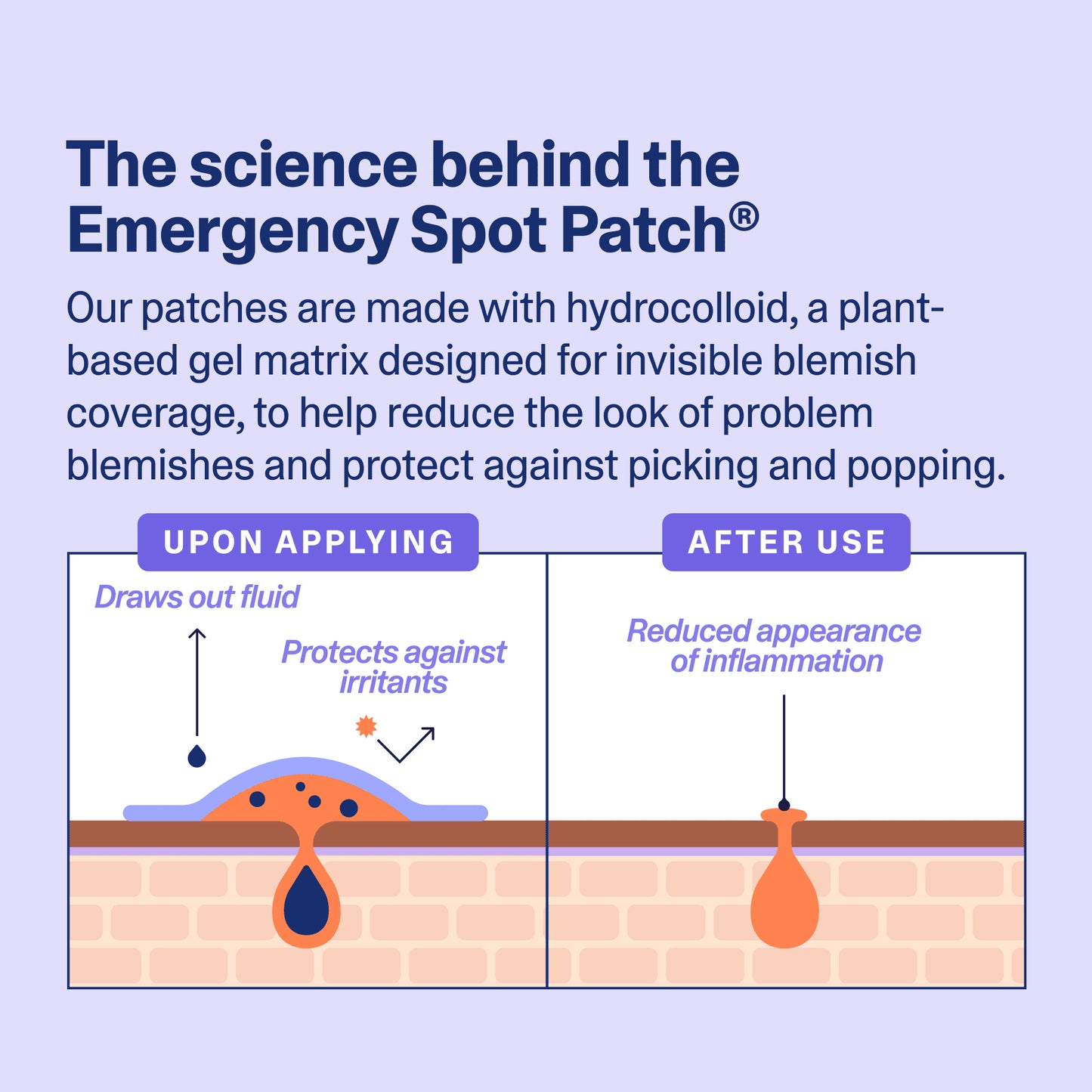 Emergency Spot Patch, Hydrocolloid Pimple Patches for Acne, 80 Count